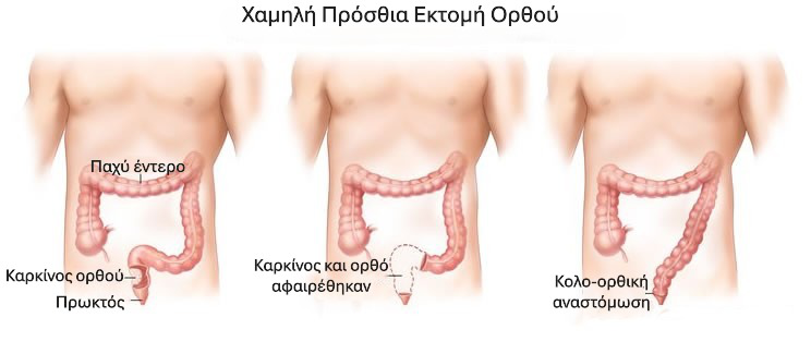 Ρομποτική εκτομή ορθού: χαμηλή πρόσθια εκτομή και κολο-ορθική αναστόμωση