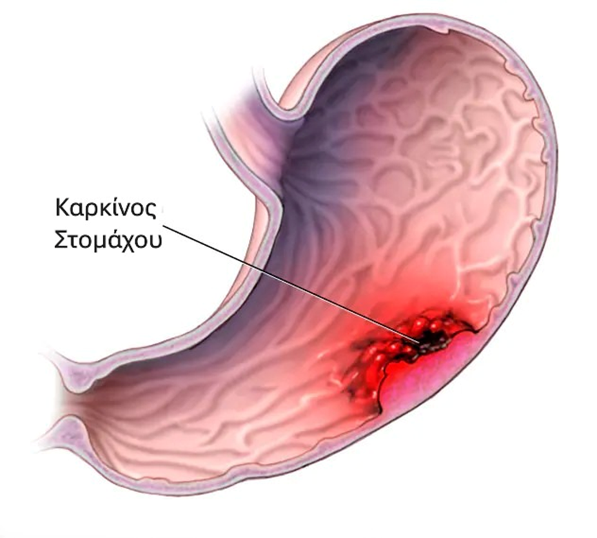 Εσωτερικό του στομάχου με καρκινική βλάβη στο κάτω μέρος του τοιχώματος