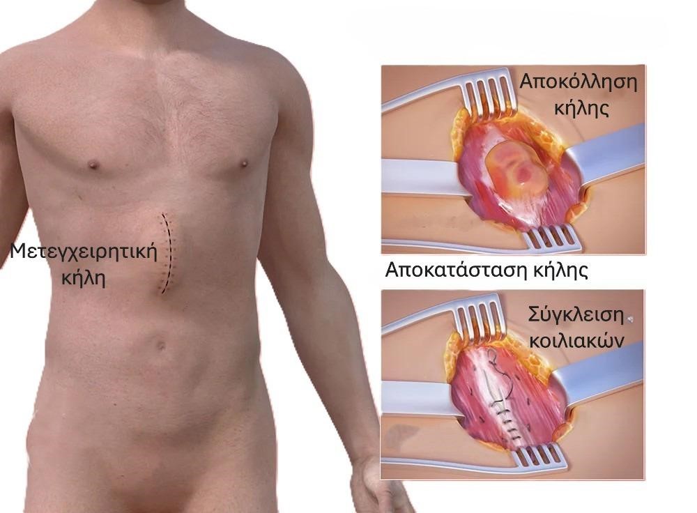Μετεγχειρητική κήλη στη μέση της κοιλιάς, με εικόνα αποκόλλησης της κήλης και σύγκλεισης των κοιλιακών μυών