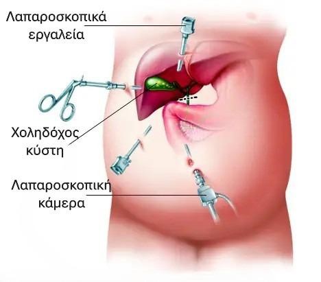 Λαπαροσκοπικά εργαλεία και λαπαροσκοπική κάμερα στην κοιλιά, με τη χοληδόχο κύστη κάτω από το ήπαρ
